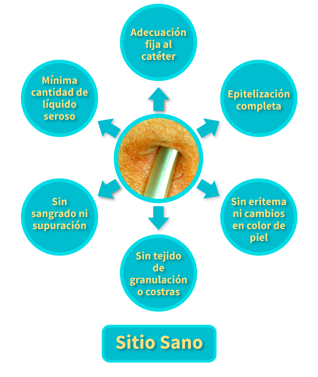 Características del sitio sano de inserción del catéter para DP