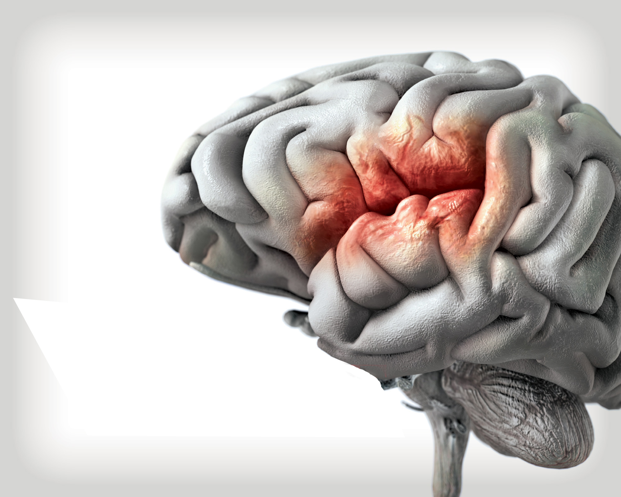 Gráfico de un cerebro con hemorragia cerebral