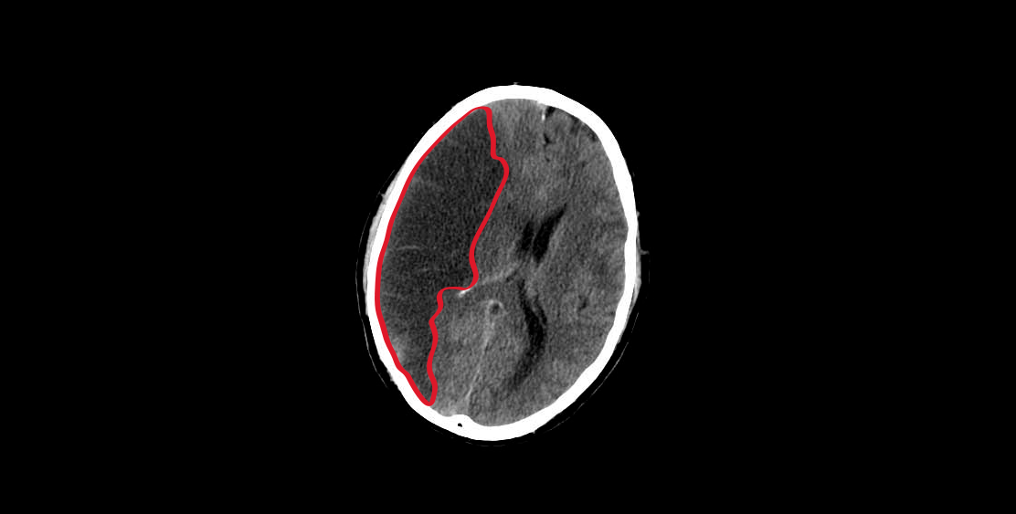 Isquemia cerebral