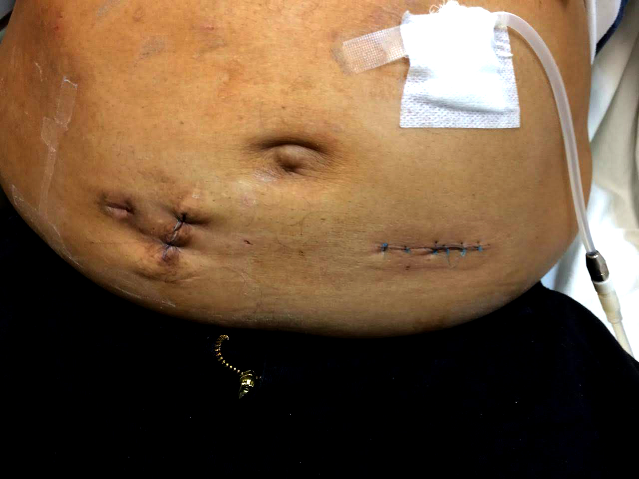 Peritoneal dialysis system on patient