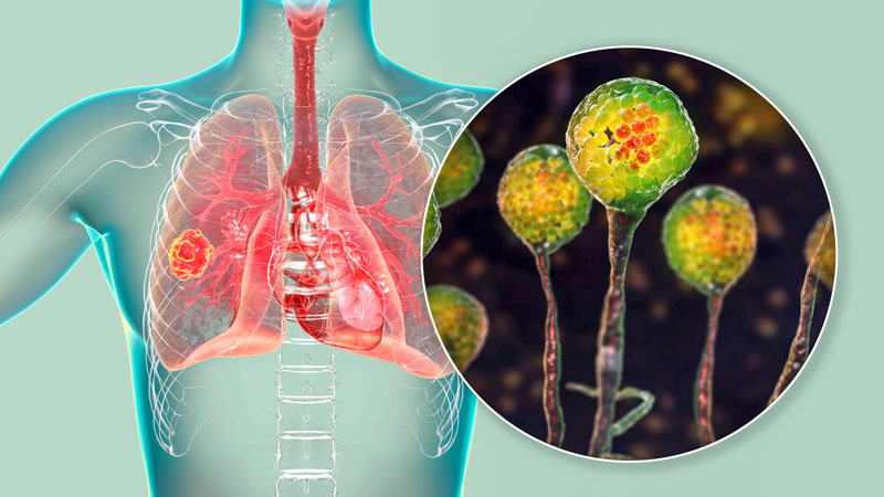 Mucormicosis pulmonar causada por hongos Mucor