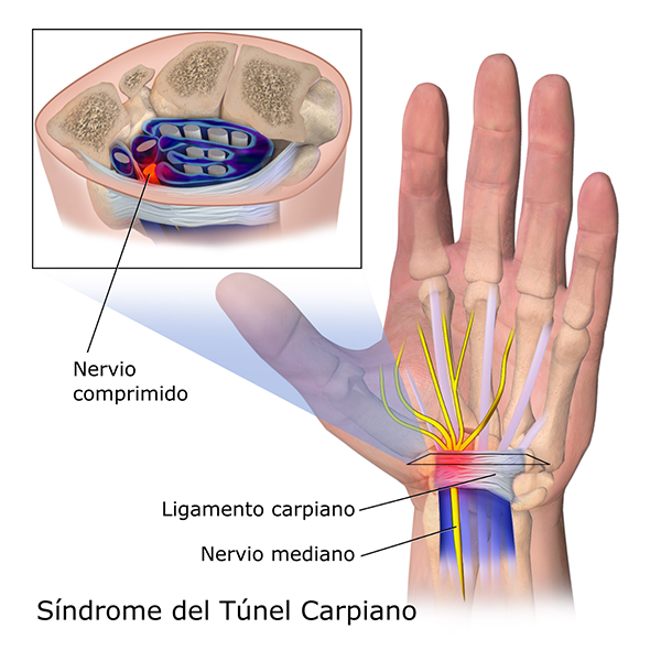 Síndrome de túnel del carpo