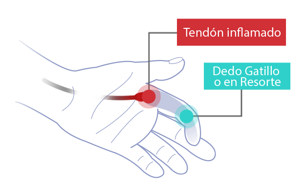 Lesión de los tendones flexores “gatillo”