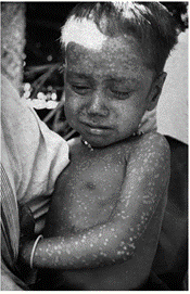 Niño enfermo de viruela.