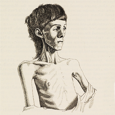 Ilustración alusiva a un hombre con anorexia. 