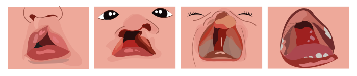 Ilustración que muestra a un niño con labio y paladar hendido.