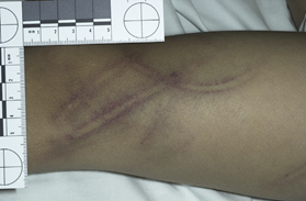 Equimosis con la forma de una hebilla de cinturón. Mecanismo de lesión: impacto a alta velocidad.