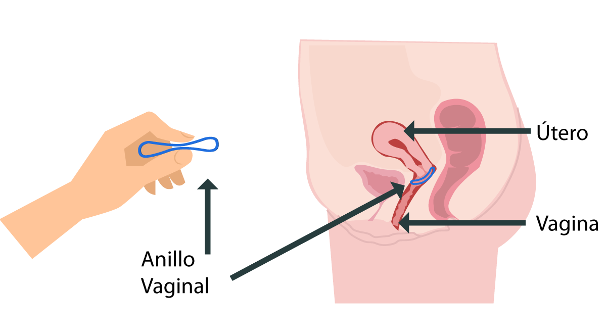 Ilustración el mecanismo el uso del anillo vaginal.
