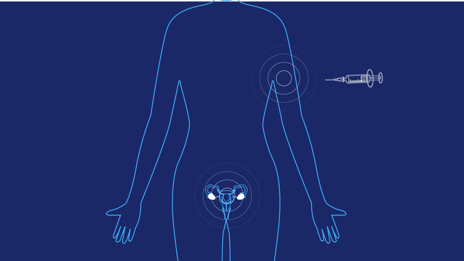 Ilustración que muestra la zona en la que se coloca el anticonceptivo inyectable en el cuerpo de la mujer.