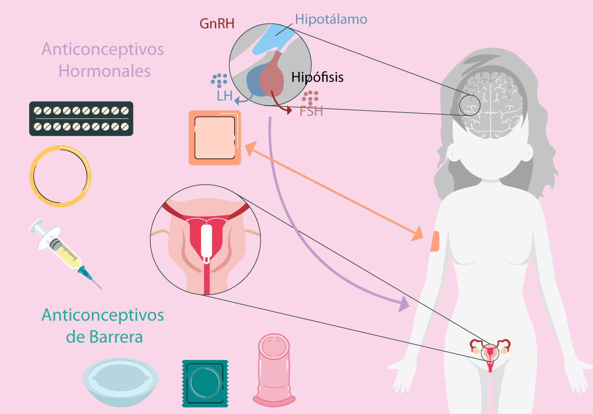 Ilustración que muestra el mecanismo de los anticonceptivos en el cuerpo de la mujer.