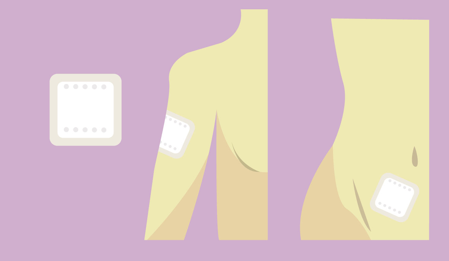 Ilustración que muestra las zonas del cuerpo en las que se coloca el parche anticonceptivo. 