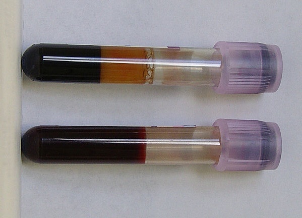 Muestras de sangre; la primera es muestra de dislipidemia