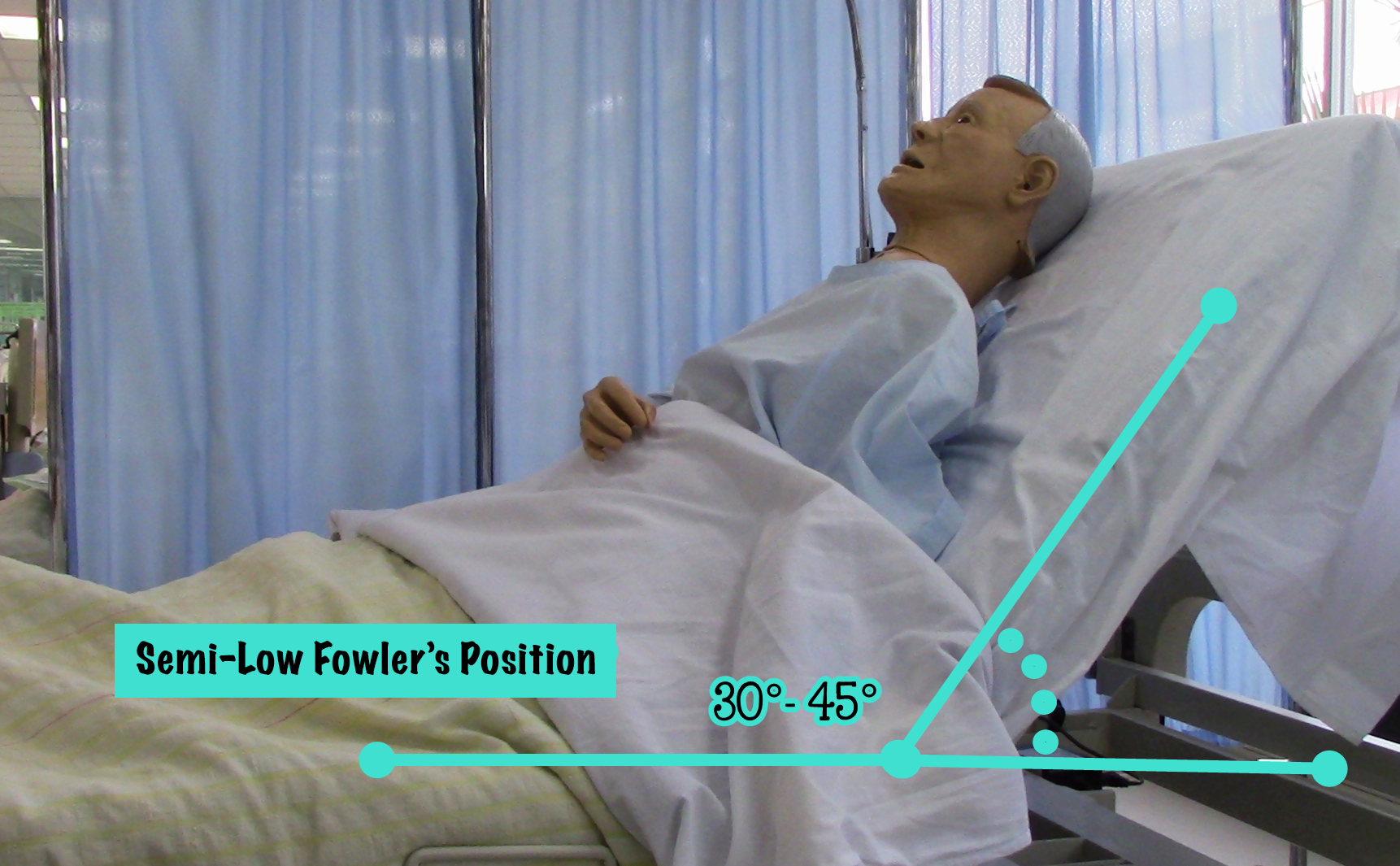 Demonstration of semi-low fowler’s position