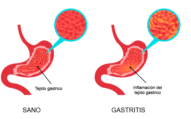 Imagen que muestra estomago sano y estomago que presenta gastritis.