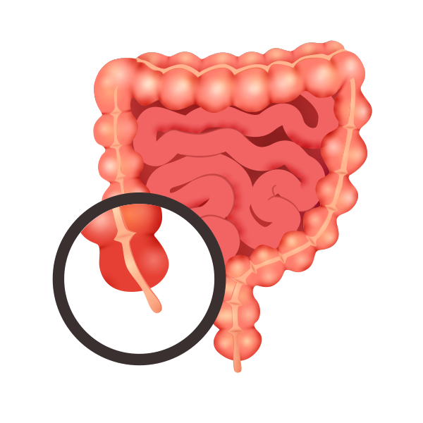 Ilustración que muestra una apendicitis aguda.